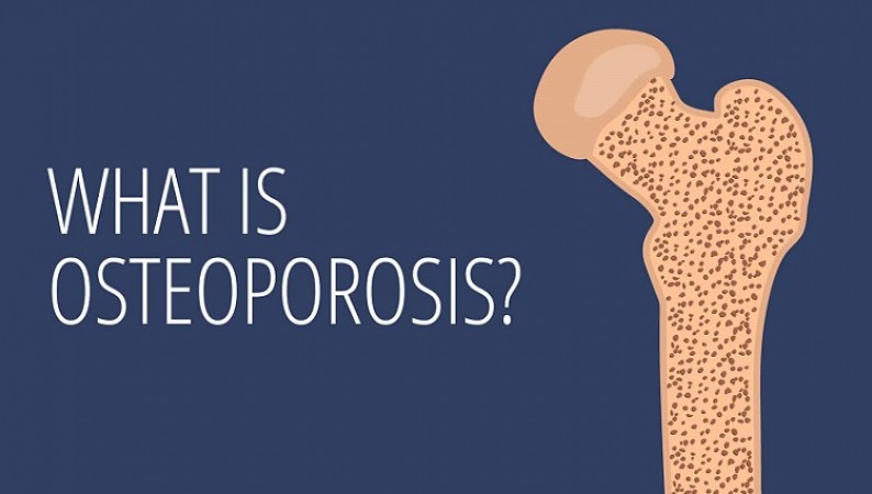 How to Prevent Osteoporosis Secrets of Calcium and Vitamin D