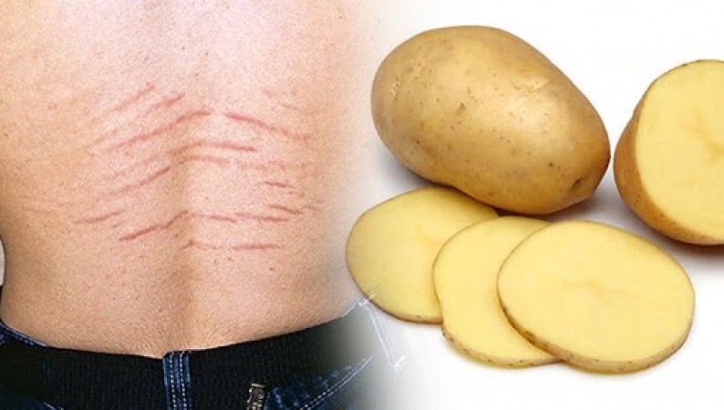 This domestic recipe helps to lighten the stretch marks
