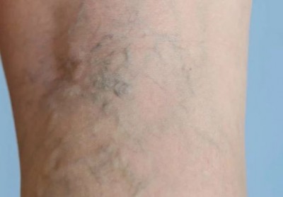 People who stand for a long time suffer from this disease, the veins in the legs become thick and black, know what is this disease