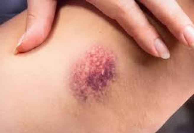 Tips for Bruises: If you have blue marks on your body after injury, try these tips, the effect will be visible soon