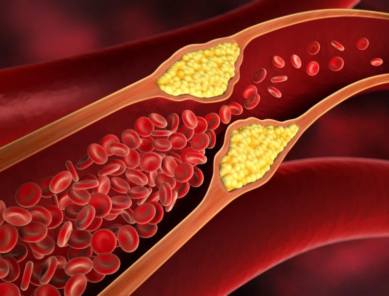These symptoms appear in the body when cholesterol increases
