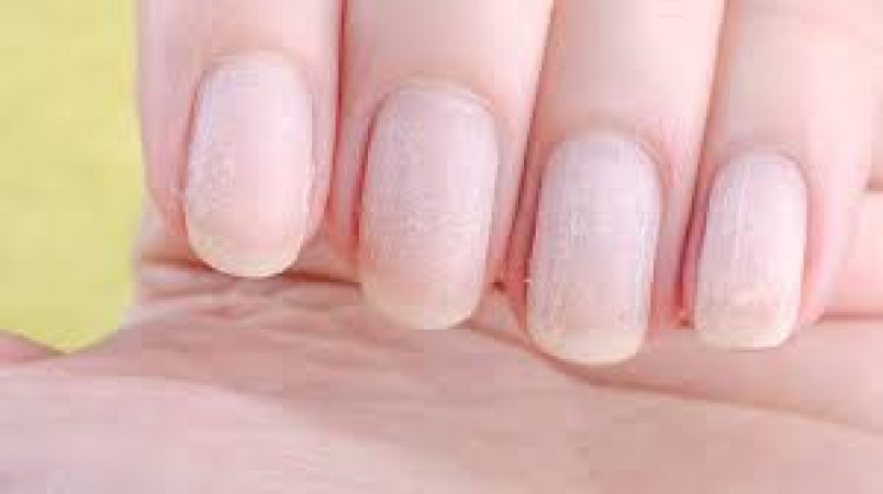 Find out from the nails whether there is a deficiency of Vitamin B12 in the body