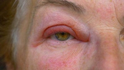 आपकी त्वचा और आंखें भी करती है किडनी की स्थिति को बायां, अगर आपको ये लक्षण दिखाई दें तो तुरंत हो जाएं सतर्क