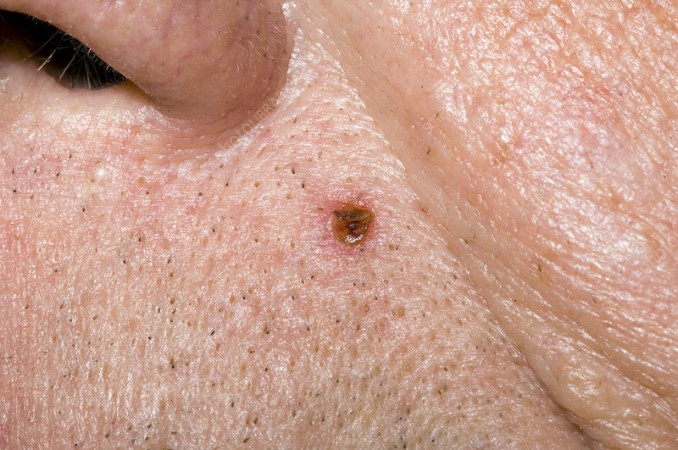 Are Men More Prone To 'Melanoma' Skin Cancer?