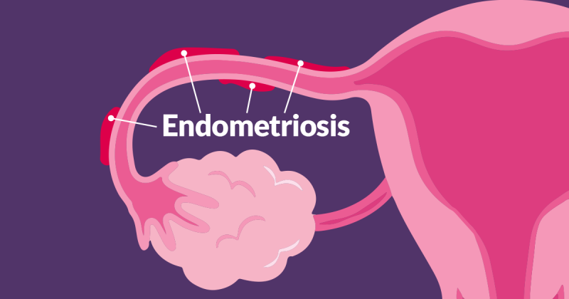 What alterations in way of life can help manage endometriosis?