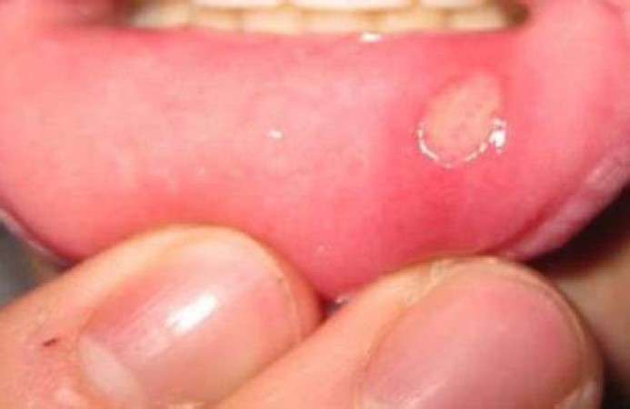 Is it too painful when you have mouth ulcers? Try these remedies to get instant relief