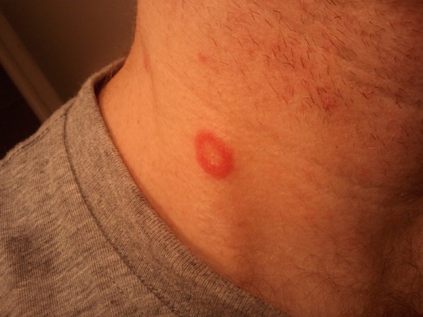 What occurs if I don't treat ringworm? See what the professionals have to say