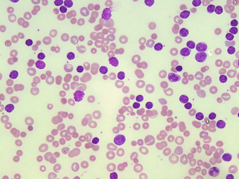 Blood Cancer Awareness Month: Understanding Lymphoma and Leukemia