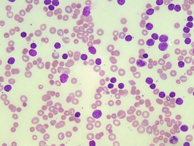 रक्त कैंसर जागरूकता माह: लिम्फोमा और ल्यूकेमिया क्या होता है ?, जानिए