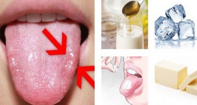 If your tongue gets burnt due to hot food then immediately adopt these home remedies... you will get relief