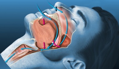 How to Sleep Soundly Without Snoring: Effective Strategies for Better Rest