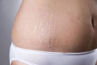 Try 2 Method to remove Stretch marks
