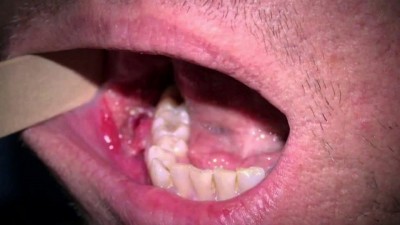 These early symptoms of mouth cancer can take a big form