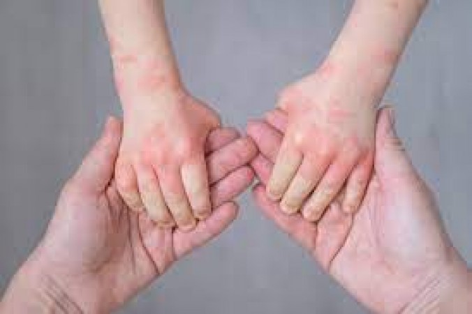 Ways to protect the child from the pain of rashes