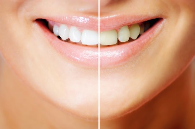 दाँतों को सफ़ेद करने के 3 कारगर उपाय
