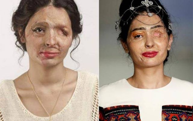 Journey of an acid attack survivor to a runway model !