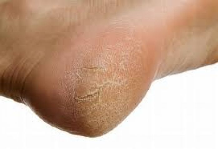 Remove your 'Callus' easily !