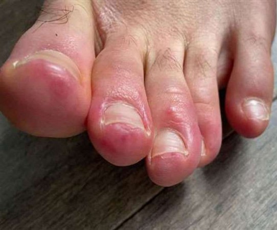Be careful if you have blue or purple marks on your foot
