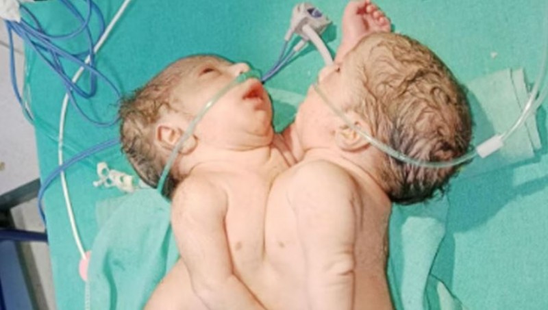 Unique twin girls born in MP! Everyone surprised to see