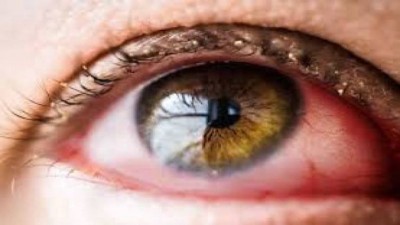 These eye problems can become a cause of corona infection