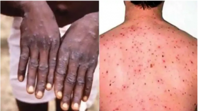 Does monkeypox spread by having a physical relationship?