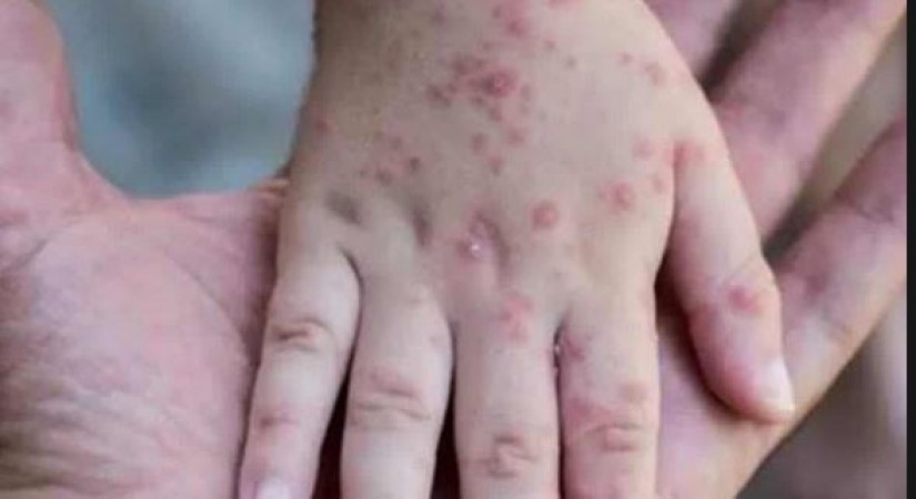 Symptoms of monkeypox seen in 8-year-old child, hospitalized