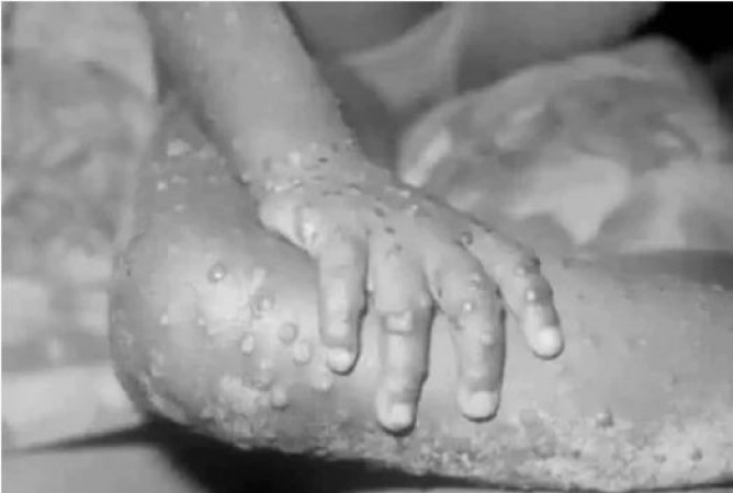Monkeypox has knocked in Ghaziabad? Symptoms seen in a 5-year-old girl