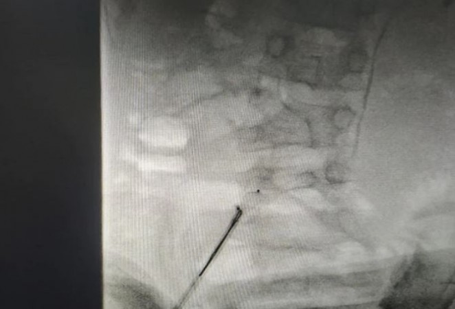 Device went inside 4-year-old innocent while closing hole in the heart, and then...