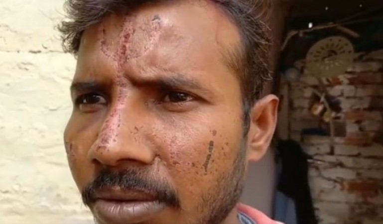 Fact Check: 'Dabangs made Trishul from acid on Dalit youth's forehead!' UP police shocking revelation