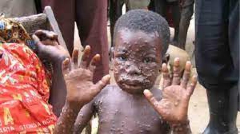 Monkeypox spread to 12 countries in just 2 weeks