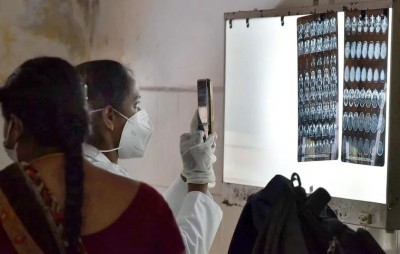 व्हाइट फंगस के कारण महिला की आंत में हो गया छेद, दिल्ली में मिला 'दुनिया' का पहला ऐसा केस