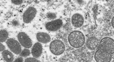 Monkeypox को लेकर दुनियाभर में हड़कंप, यूपी सरकार ने भी जारी की एडवाइजरी