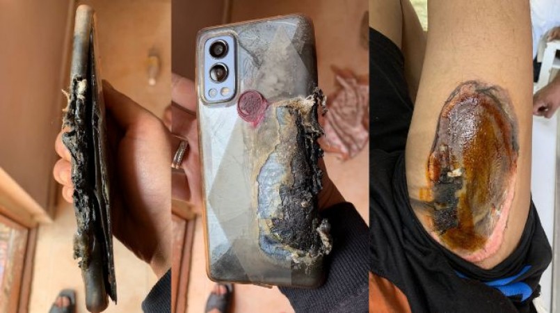 OnePlus's phone explodes for the third time, youth's thigh badly injured in accident