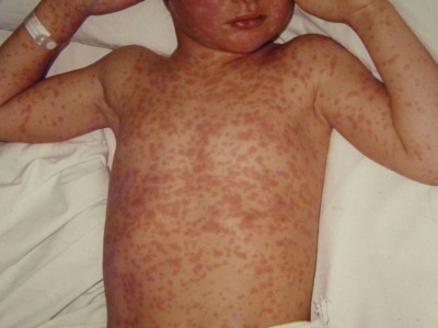 Measles started wreaking havoc, 12 patients died