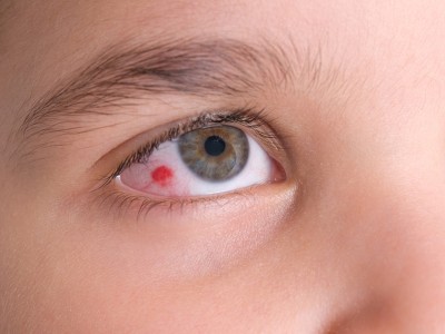 अगर आपकी आँखों में जम रहे हैं 'लाल थक्के' तो हो सकता है कोरोना, सामने आए महामारी के नए लक्षण