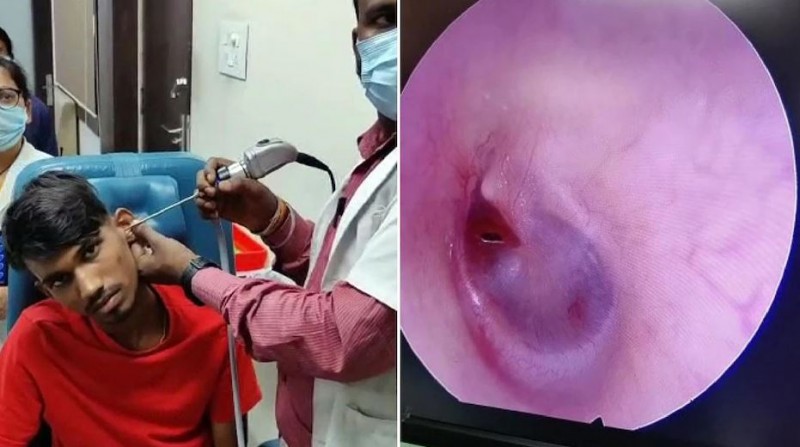 Young man had severe pain in his ear when he woke up, stunned when got examined