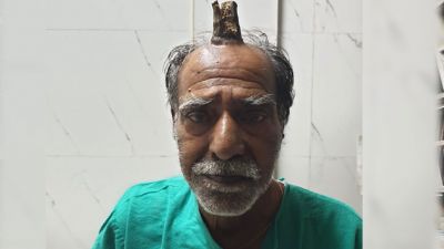 Horn grown on human's head, doctors also shocked after seeing it