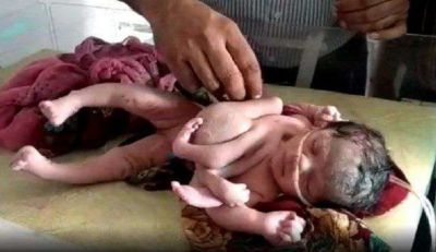 राजस्थान में जन्मा चार हाथों वाला बच्चा, देखने के लिए लगी लोगों की भीड़