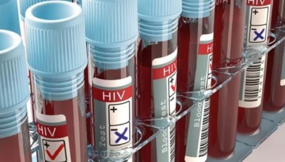 इस राज्य के कैंपसों में पसरा AIDS, 828 छात्र पाए गए HIV पॉजिटिव, 47 की हो चुकी है मौत
