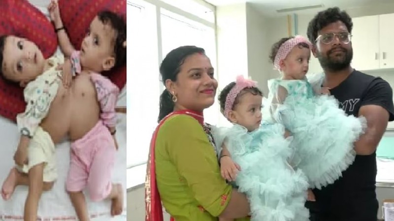 जन्म से जुड़ी जुड़वा बहनों को AIIMS के डॉक्टरों ने 9 घंटे में किया अलग, मासूमों को मिली नई जिंदगी