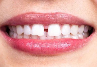 दांतों के बीच में गैप होना शुभ है या अशुभ? यहाँ जानिए