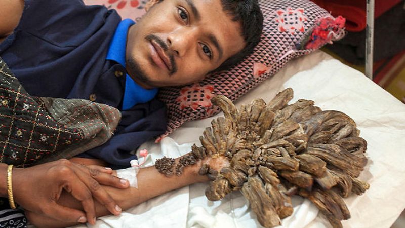 'Tree man' Abul Bajandar readmitted in the  hospital for few more surgeries