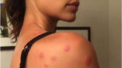 A model to sue a hotel for being bitten by bed-bug