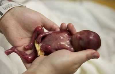 Have A Look At these Petrifying Yet Heart Rending Pictures Of Abortion