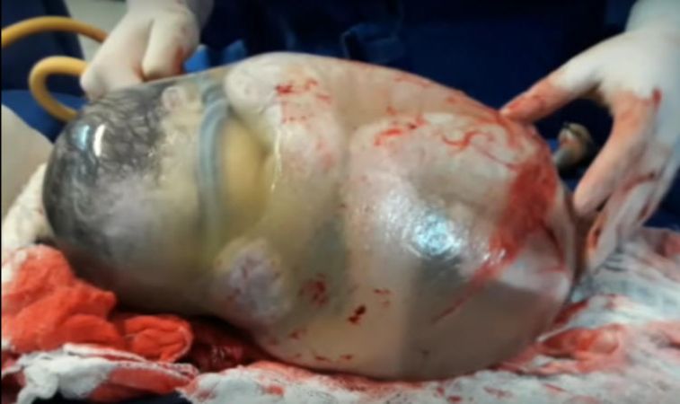 New Miracle: A Baby Was Born In An Amniotic Sac Which Is Very Rare