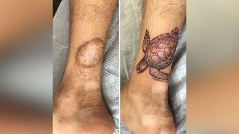 Tattooing is the nice trick to cover scars, see in pictures!