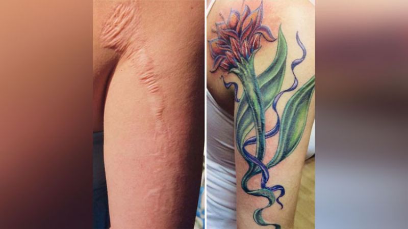 Tattooing is the nice trick to cover scars, see in pictures!