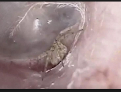 A tiny spider web found inside the Ear of a Man; video goes viral