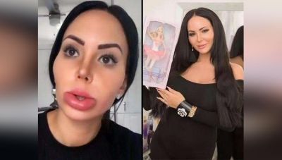 200 Plastic Surgeries drastically changes the facial look of this Model !