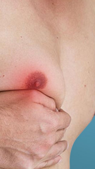 पुरुष भी हो सकते हैं स्तन कैंसर का शिकार, दिखते हैं ये लक्षण